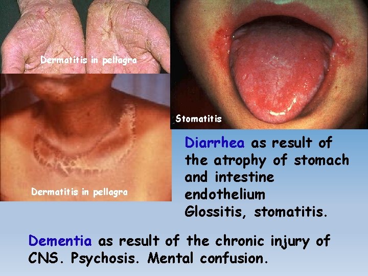 Dermatitis in pellagra Stomatitis Dermatitis in pellagra Diarrhea as result of the atrophy of