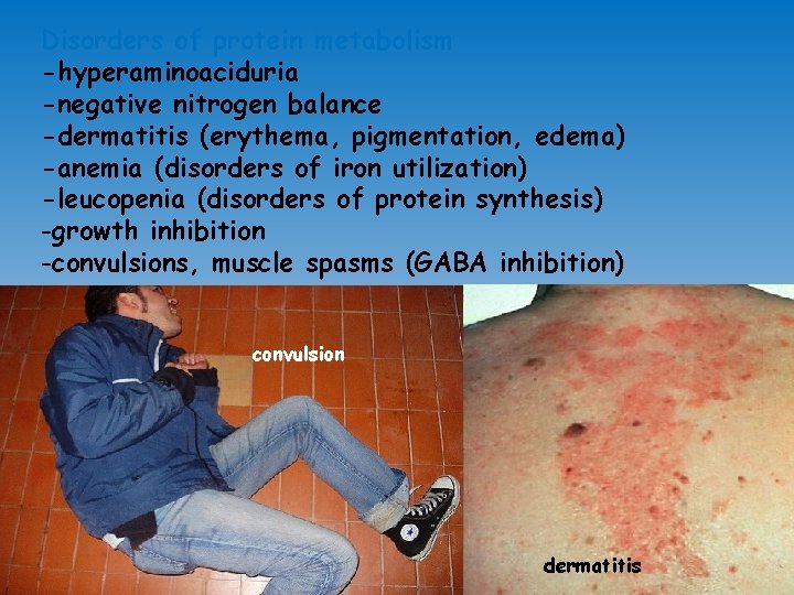 Disorders of protein metabolism -hyperaminoaciduria -negative nitrogen balance -dermatitis (erythema, pigmentation, edema) -anemia (disorders