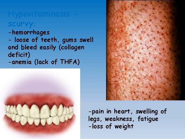 Hypovitaminosis scurvy: -hemorrhages - loose of teeth, gums swell and bleed easily (collagen deficit)