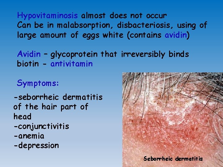 Hypovitaminosis almost does not occur Can be in malabsorption, disbacteriosis, using of large amount