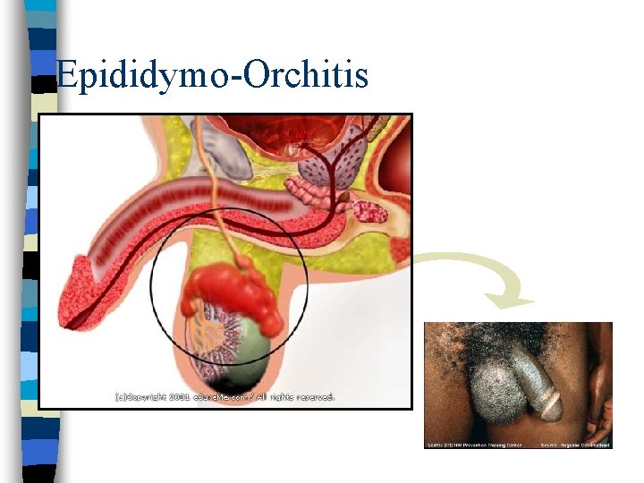 Epididymo-Orchitis 