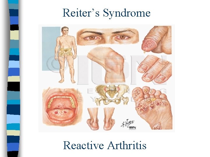 Reiter’s Syndrome Reactive Arthritis 