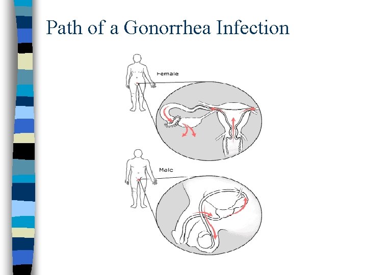 Path of a Gonorrhea Infection 