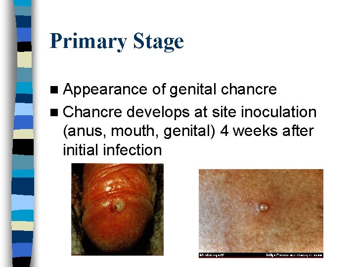 Primary Stage n Appearance of genital chancre n Chancre develops at site inoculation (anus,