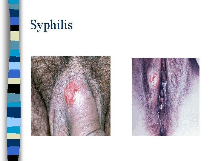 Syphilis 