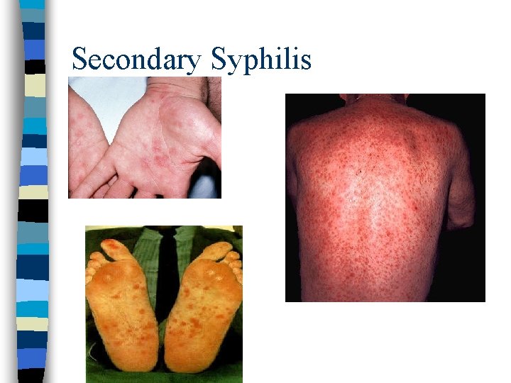 Secondary Syphilis 