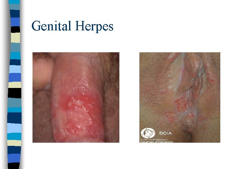 Genital Herpes 