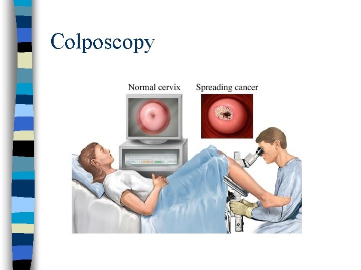 Colposcopy 