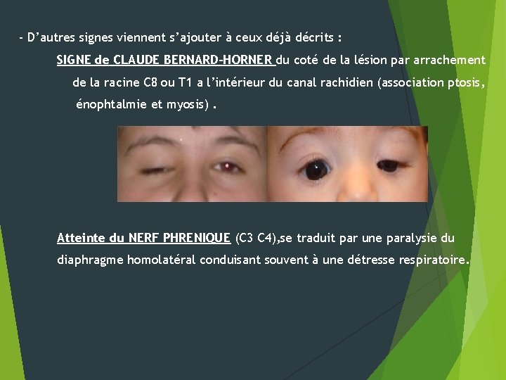 - D’autres signes viennent s’ajouter à ceux déjà décrits : SIGNE de CLAUDE BERNARD-HORNER