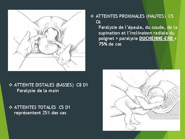 v ATTEINTES PROXIMALES (HAUTES) C 5 C 6 Paralysie de l’épaule, du coude, de