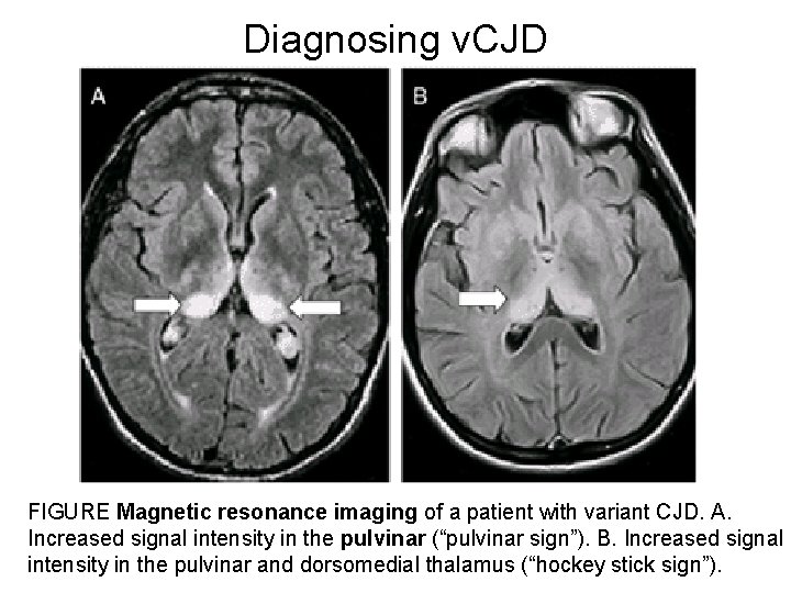 Diagnosing v. CJD FIGURE Magnetic resonance imaging of a patient with variant CJD. A.