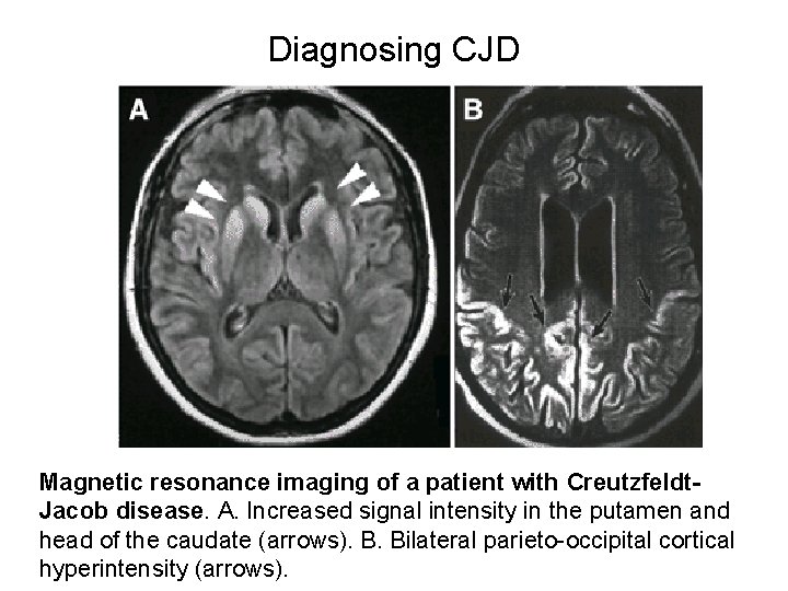 Diagnosing CJD Magnetic resonance imaging of a patient with Creutzfeldt. Jacob disease. A. Increased