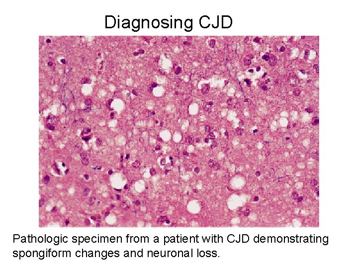 Diagnosing CJD Pathologic specimen from a patient with CJD demonstrating spongiform changes and neuronal