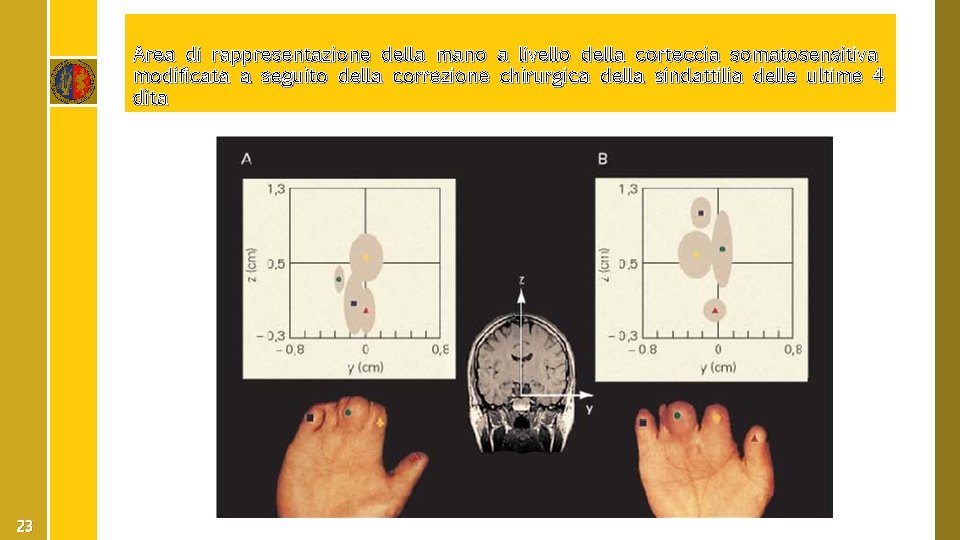 Area di rappresentazione della mano a livello della corteccia somatosensitiva modificata a seguito della