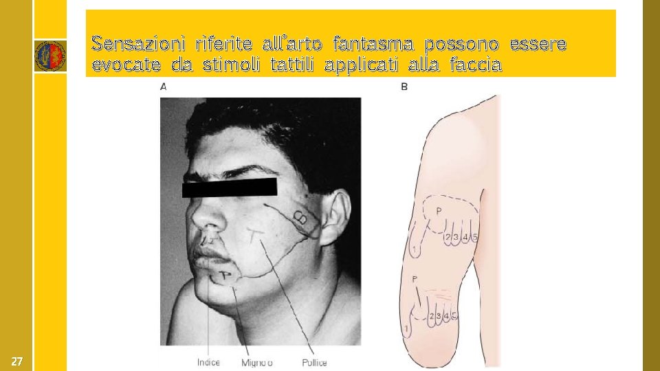 Sensazioni riferite all’arto fantasma possono essere evocate da stimoli tattili applicati alla faccia 27