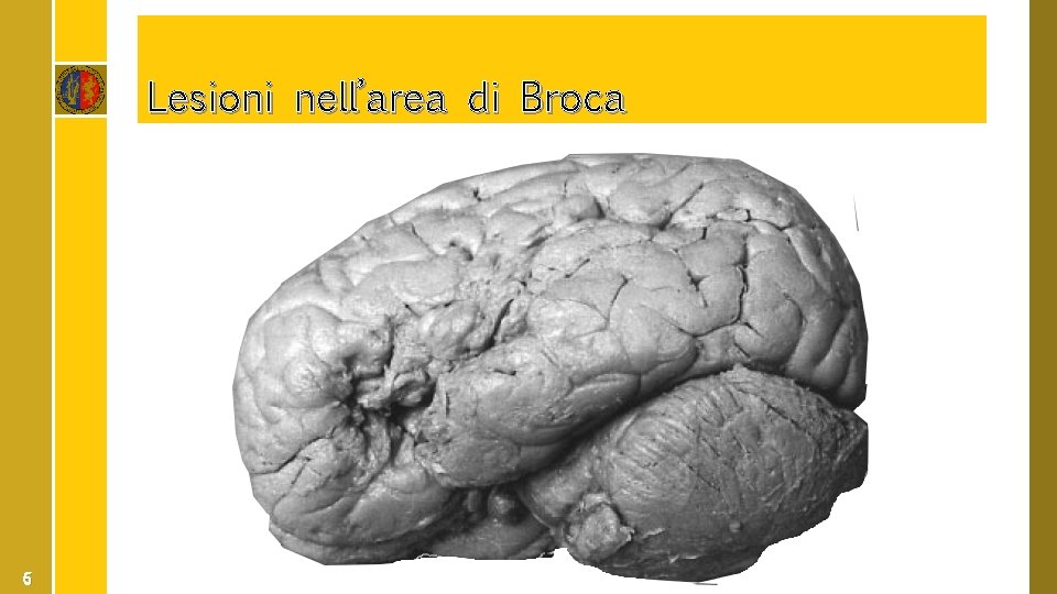 Lesioni nell’area di Broca 6 