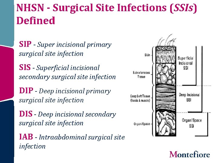 NHSN - Surgical Site Infections (SSIs) Defined SIP - Super incisional primary surgical site