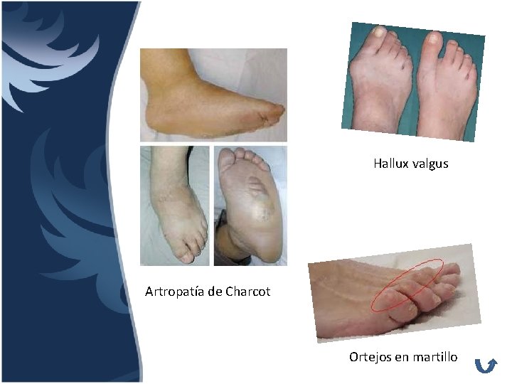 Hallux valgus Artropatía de Charcot Ortejos en martillo 