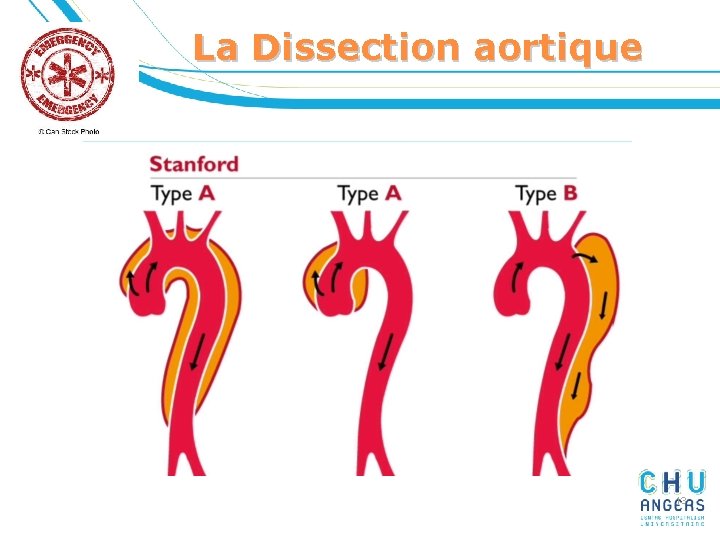 La Dissection aortique 13 