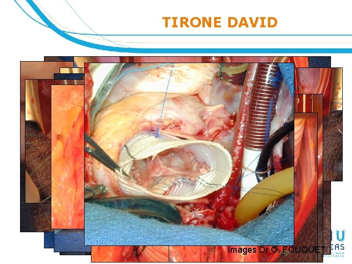 TIRONE DAVID Technique opératoire : T. DAVID Images Dr O. FOUQUET 