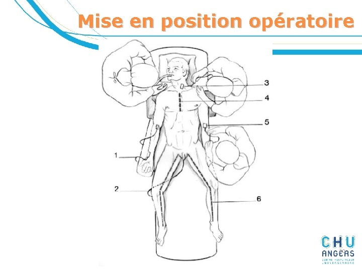 Mise en position opératoire 30 