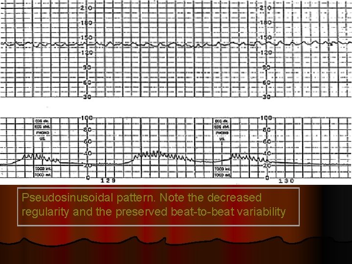 Pseudosinusoidal pattern. Note the decreased regularity and the preserved beat-to-beat variability 