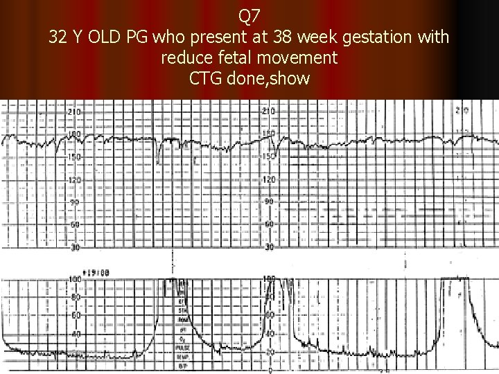 Q 7 32 Y OLD PG who present at 38 week gestation with reduce