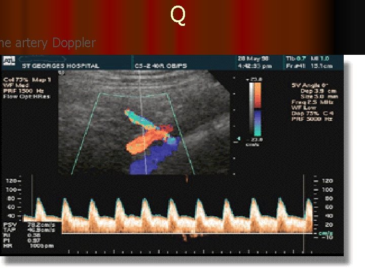 ne artery Doppler Q 