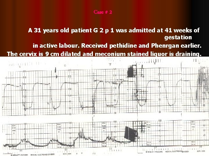 Case # 2 A 31 years old patient G 2 p 1 was admitted