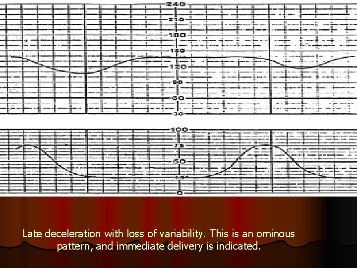 Late deceleration with loss of variability. This is an ominous pattern, and immediate delivery