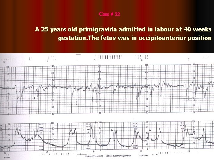 Case # 22 A 25 years old primigravida admitted in labour at 40 weeks