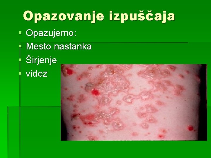 Opazovanje izpuščaja § § Opazujemo: Mesto nastanka Širjenje videz 