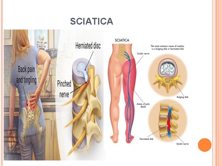 SCIATICA 