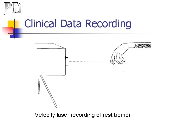 Clinical Data Recording Velocity laser recording of rest tremor 