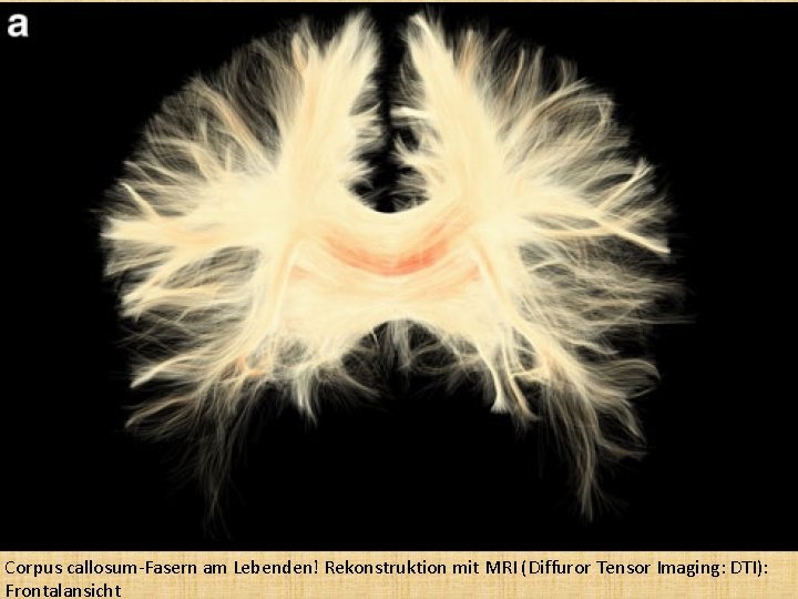 Corpus callosum-Fasern am Lebenden! Rekonstruktion mit MRI (Diffuror Tensor Imaging: DTI): Frontalansicht 