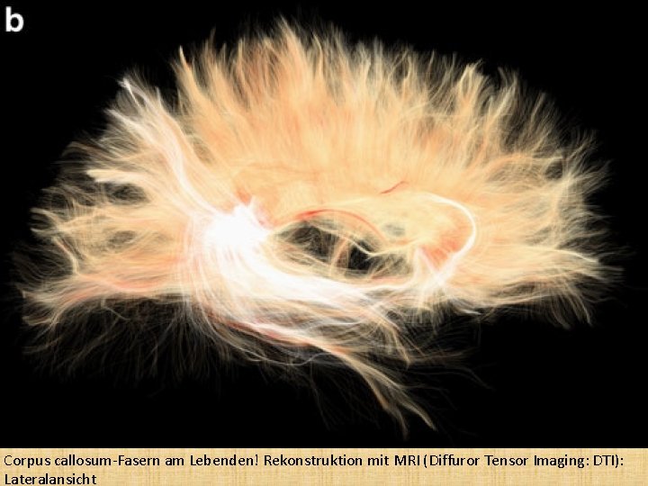 Corpus callosum-Fasern am Lebenden! Rekonstruktion mit MRI (Diffuror Tensor Imaging: DTI): Lateralansicht 
