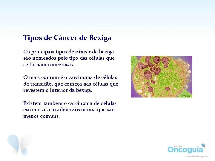Tipos de Câncer de Bexiga Os principais tipos de câncer de bexiga são nomeados