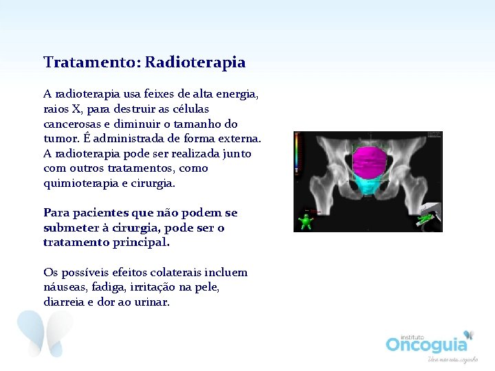 Tratamento: Radioterapia A radioterapia usa feixes de alta energia, raios X, para destruir as