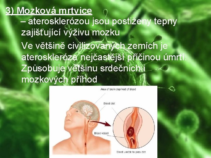 3) Mozková mrtvice – aterosklerózou jsou postiženy tepny zajišťující výživu mozku Ve většině civilizovaných