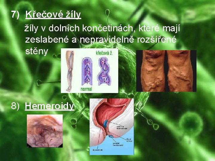 7) Křečové žíly v dolních končetinách, které mají zeslabené a nepravidelně rozšířené stěny 8)