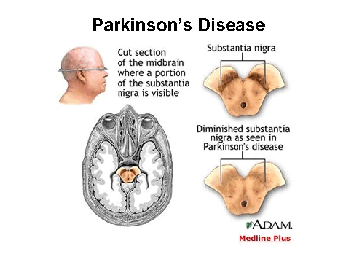 Parkinson’s Disease 