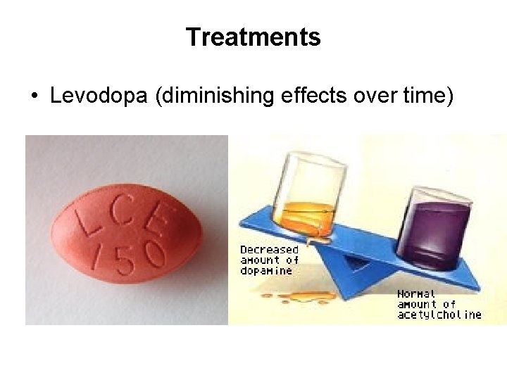 Treatments • Levodopa (diminishing effects over time) 