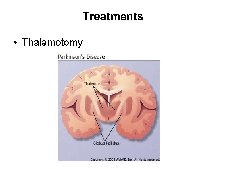 Treatments • Thalamotomy 