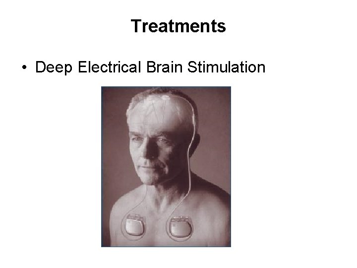 Treatments • Deep Electrical Brain Stimulation 