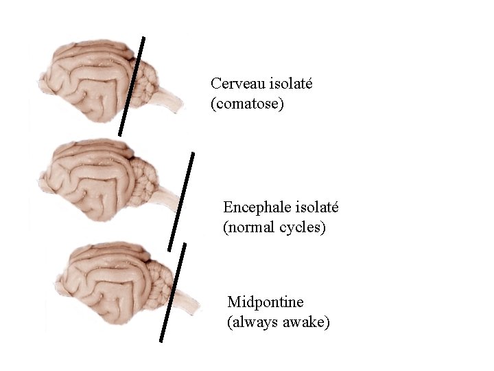 Cerveau isolaté (comatose) Encephale isolaté (normal cycles) Midpontine (always awake) 