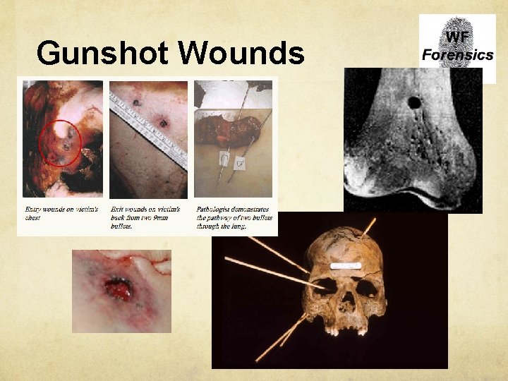 Gunshot Wounds 