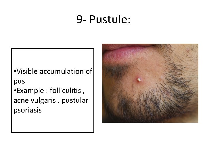 9 - Pustule: • Visible accumulation of pus • Example : folliculitis , acne