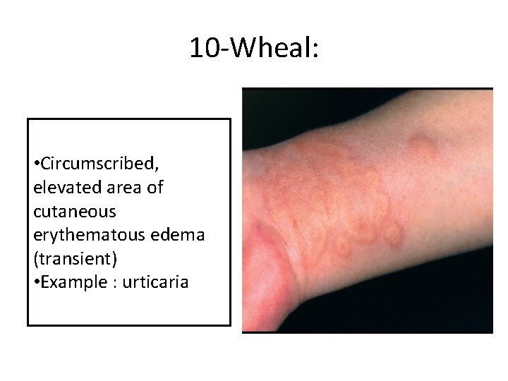 10 -Wheal: • Circumscribed, elevated area of cutaneous erythematous edema (transient) • Example :