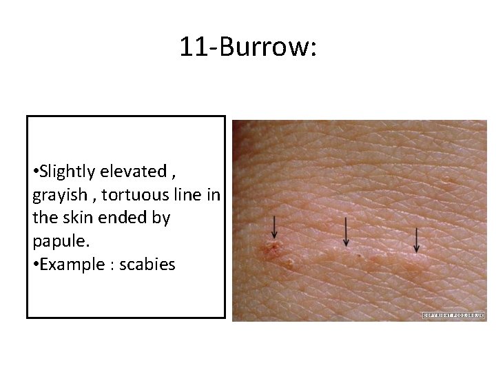 11 -Burrow: • Slightly elevated , grayish , tortuous line in the skin ended