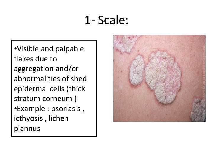 1 - Scale: • Visible and palpable flakes due to aggregation and/or abnormalities of